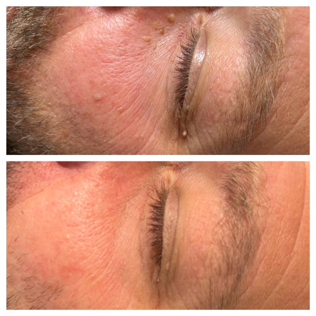 Voor en na resultaat verwijderen van huidoneffenheden rondom oog bij man in Enschede