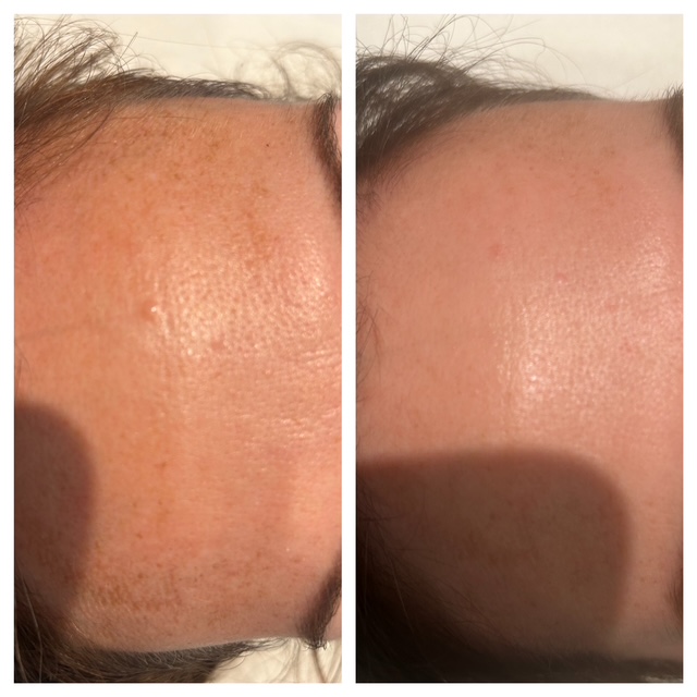 Voor en na resultaat bindweefselbultje verwijderen op voorhoofd bij vrouw in Enschede