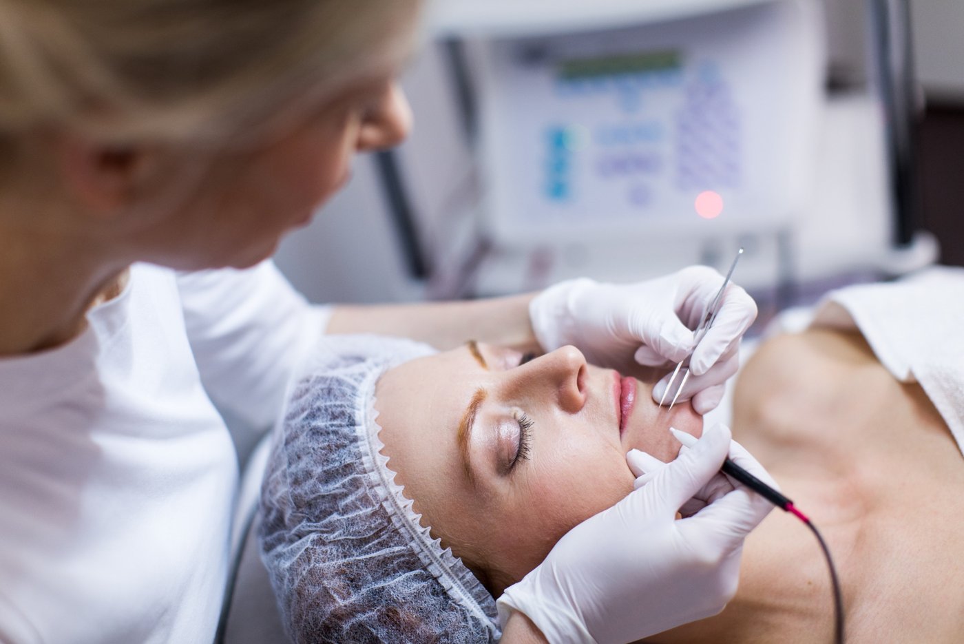 Behandeling voor definitieve ontharing met elektrisch epileren bij Huidinstituut Mariposas in Enschede
