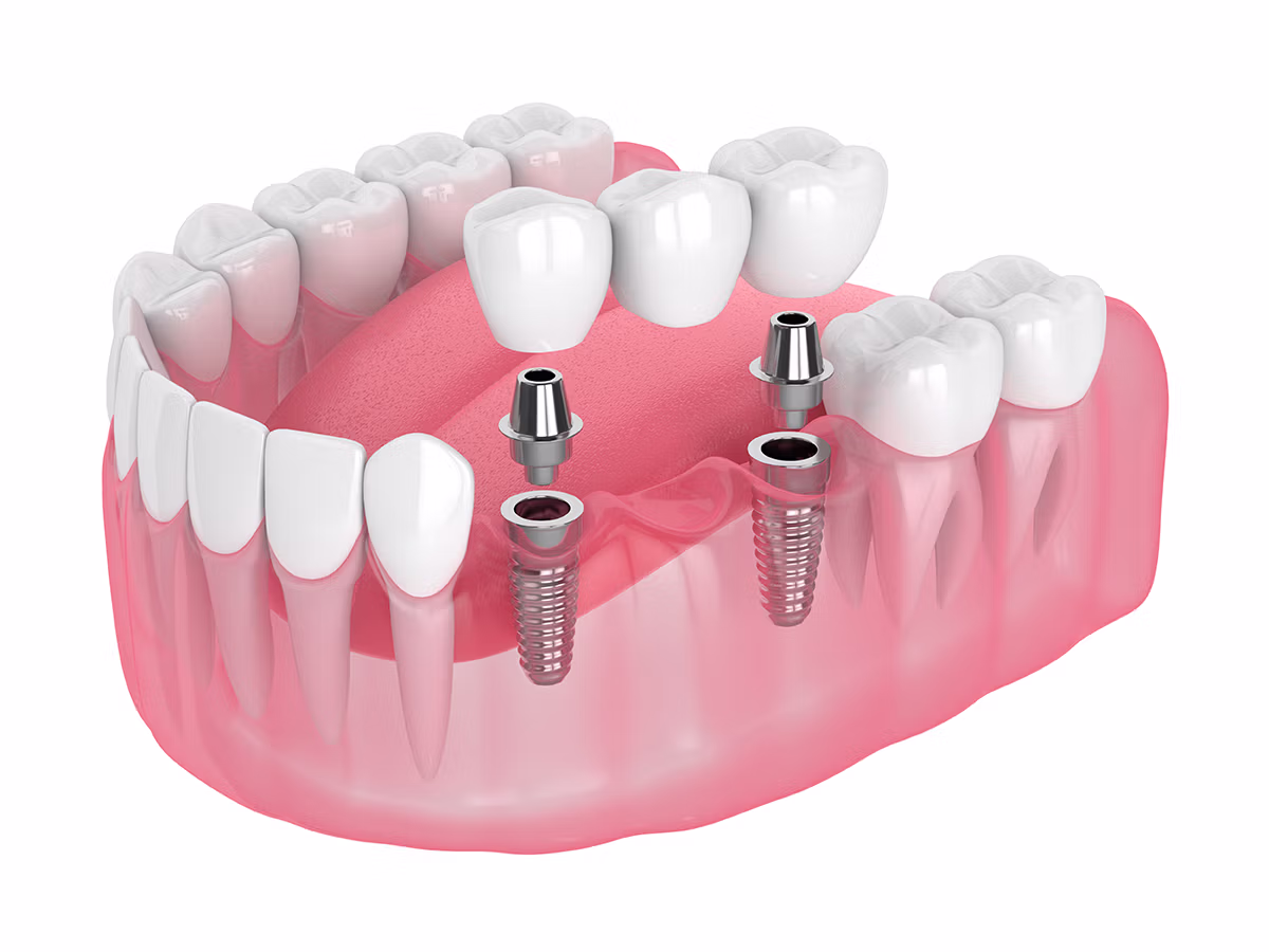 3D illustration of lower jaw with two dental implants and crowns showing implant abutments inside pink gums.