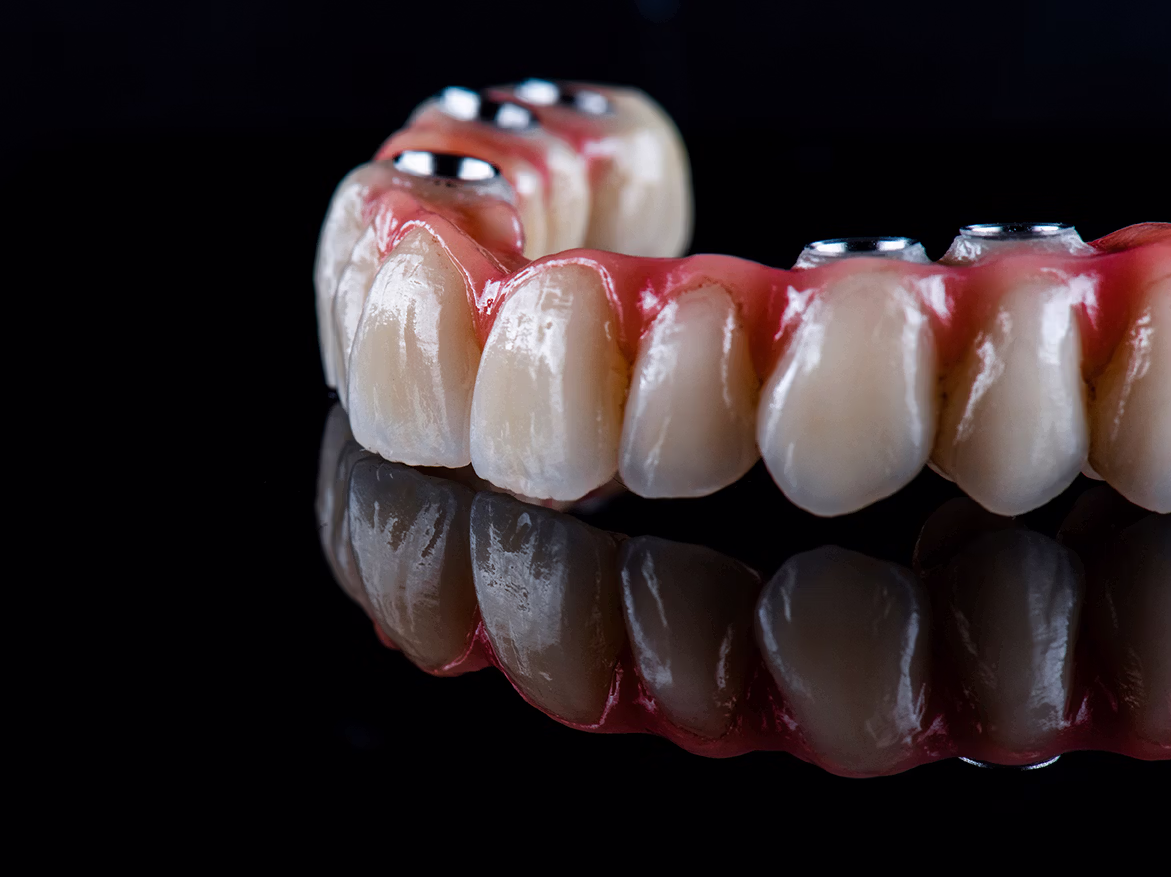 Close-up of a dental implant prosthesis showing artificial teeth attached to metal abutments with gum-colored base.