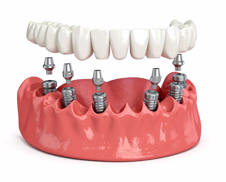 3D illustration of dental implants embedded in lower jawbone with abutments connecting to a set of artificial teeth above.