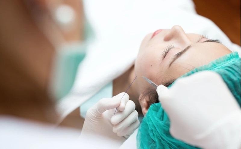 Thẩm mỹ căng chỉ da mặt giữ được bao lâu thì trở lại như ban đầu?