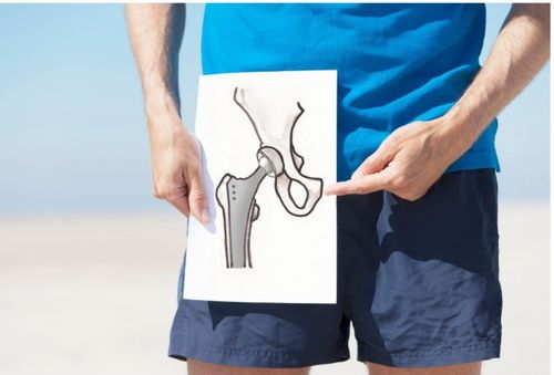 Dolore all’anca? Potrebbe essere coxartrosi. Scopri come riconoscerla e curarla