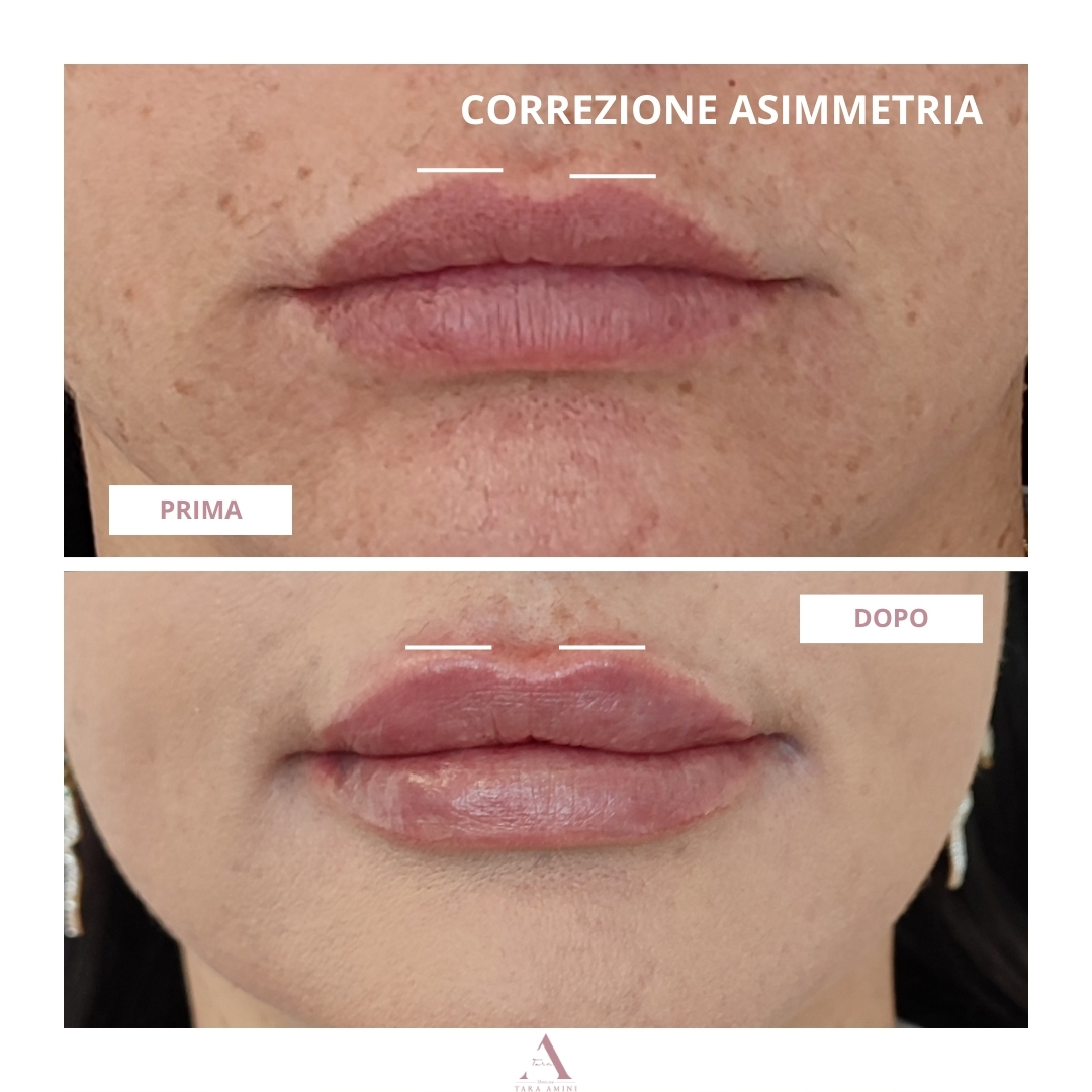 filler per correzione asimmetria