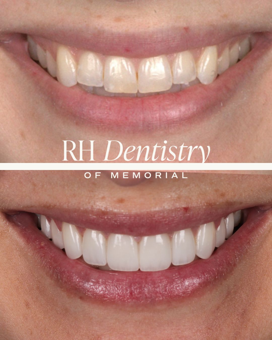 memorial houston dental veneers