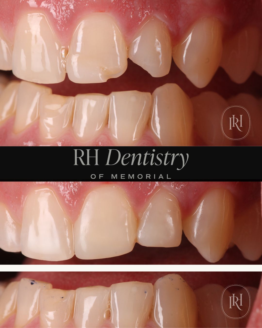 Dental Bonding in Memorial, Houston