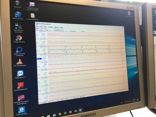 monitor showing bio markers of patient