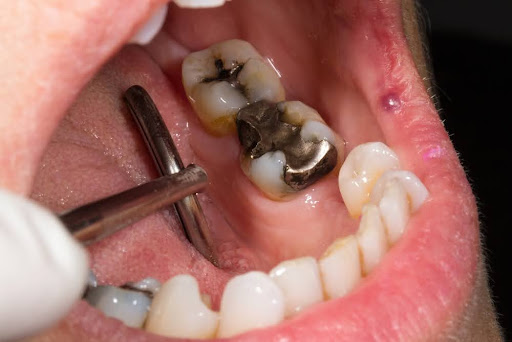Dental Bonding - An open mouth with golden inlays