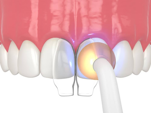 Dental Bonding Diagram