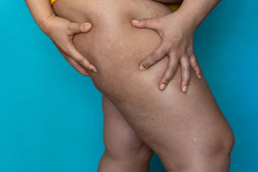 Lipedema nas pernas: qual é a importância da atividade física?