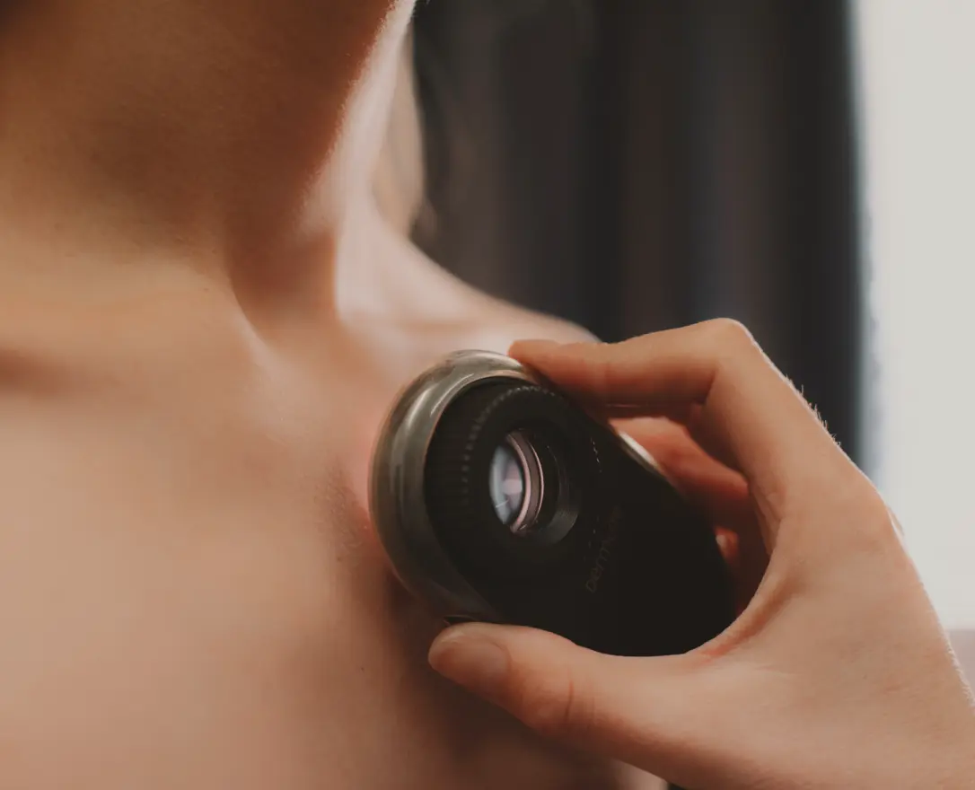 melanotan freckles reddit Melanoma Images: What Does Melanoma Look Like?