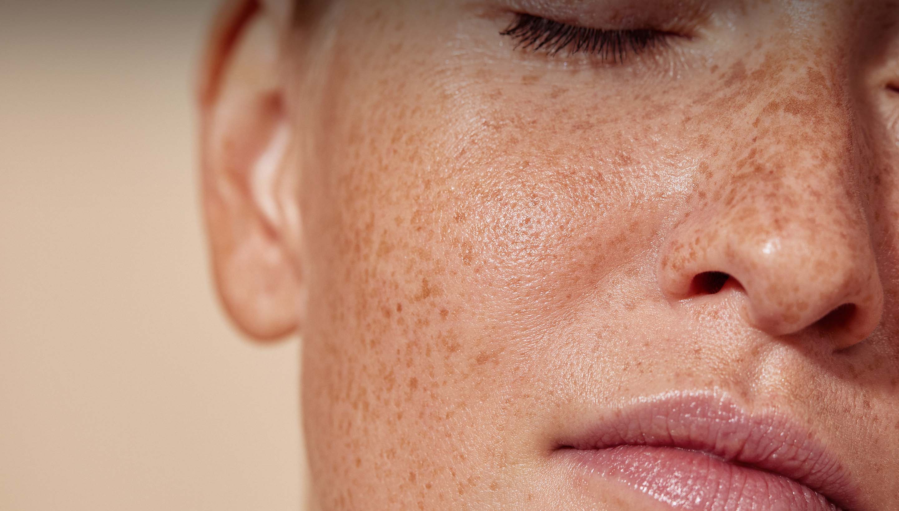 Close-u photo of a woman's face with some spots and freckles