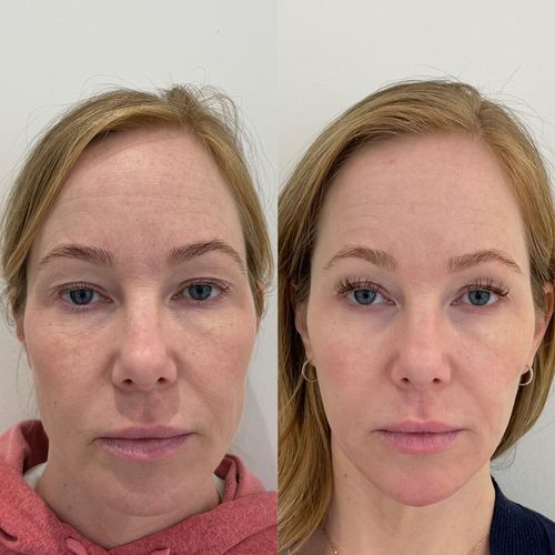 Full Face Rejuvenation Example 1