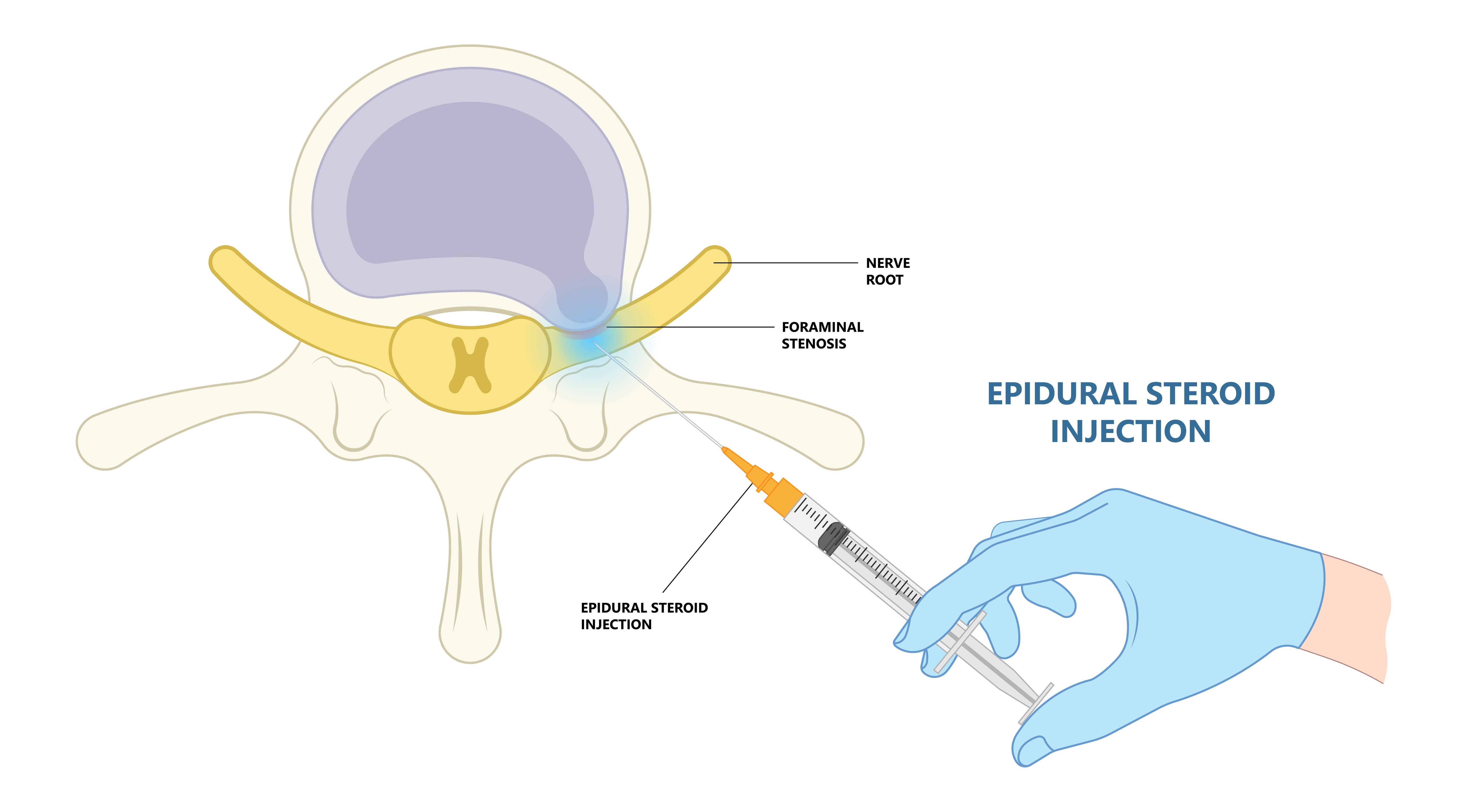 Do I need an injection for a Prolapsed Lumbar Disc? 