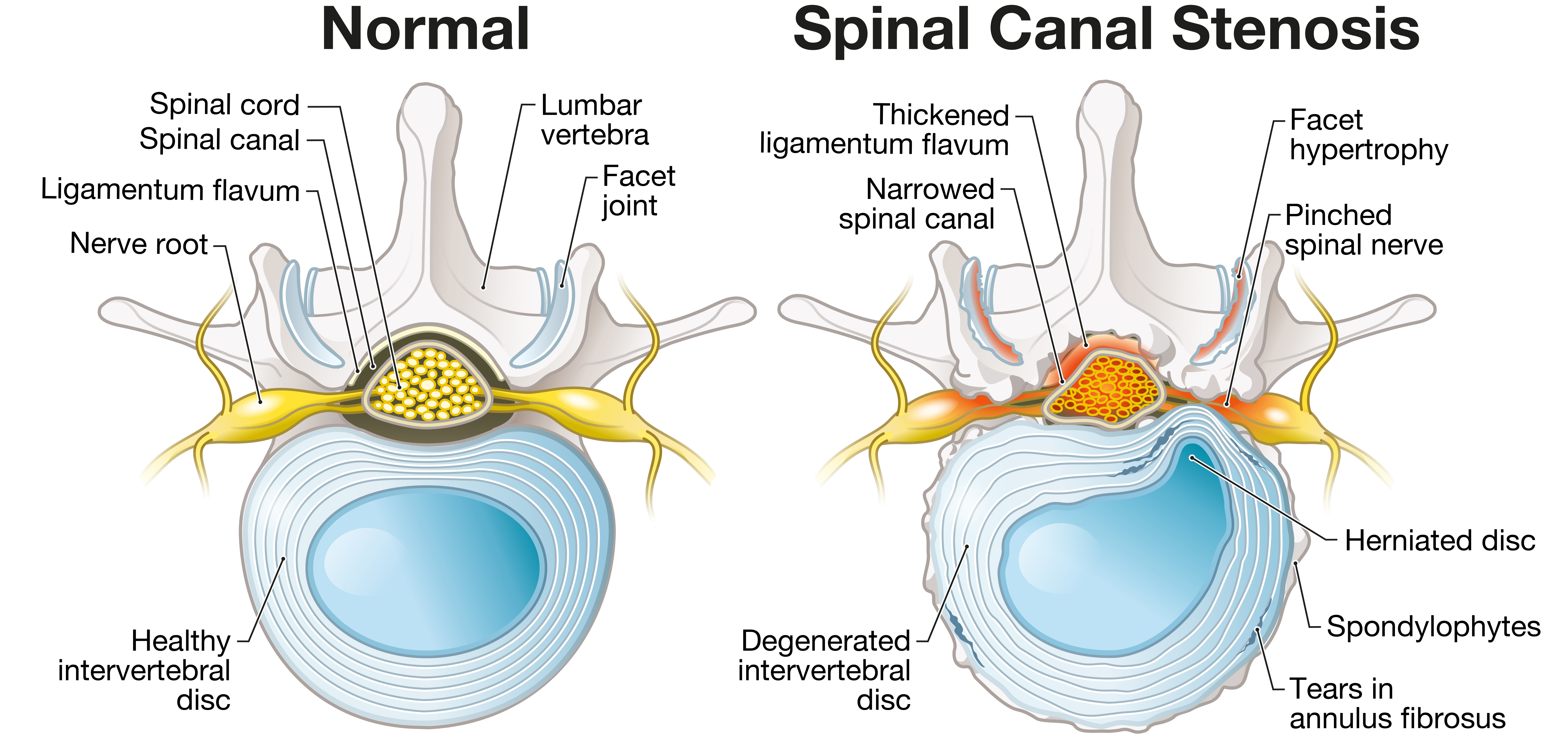 Lumbar Spinal Stenosis: Is Surgery the Right Option for You?