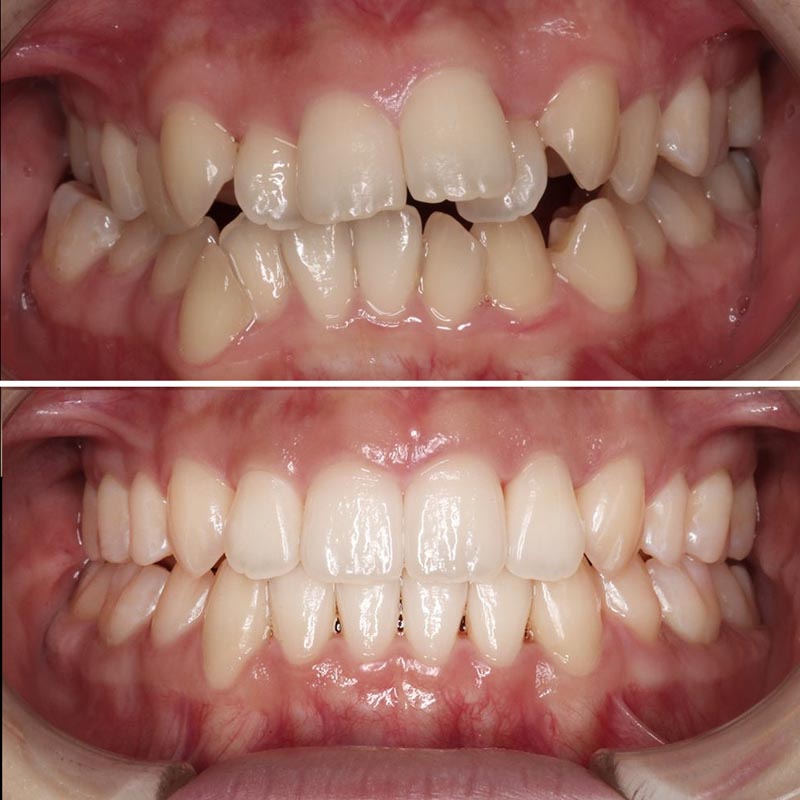 Invisalign Vorher Nachher Vergleich - Echte Ergebnisse aus Berlin Friedrichshain