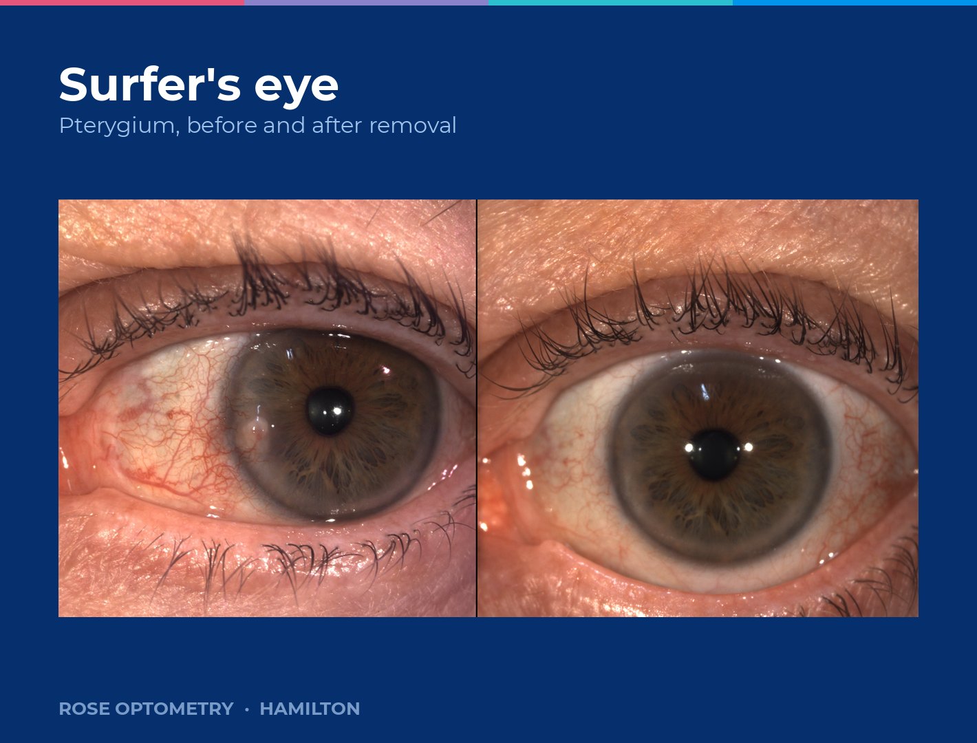 An eye with a pterygium before removal, alongside the same eye after surgery