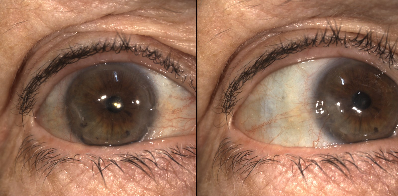 Slit lamp photographs of a pterygium, a wing-shaped growth extending from the conjunctiva onto the cornea