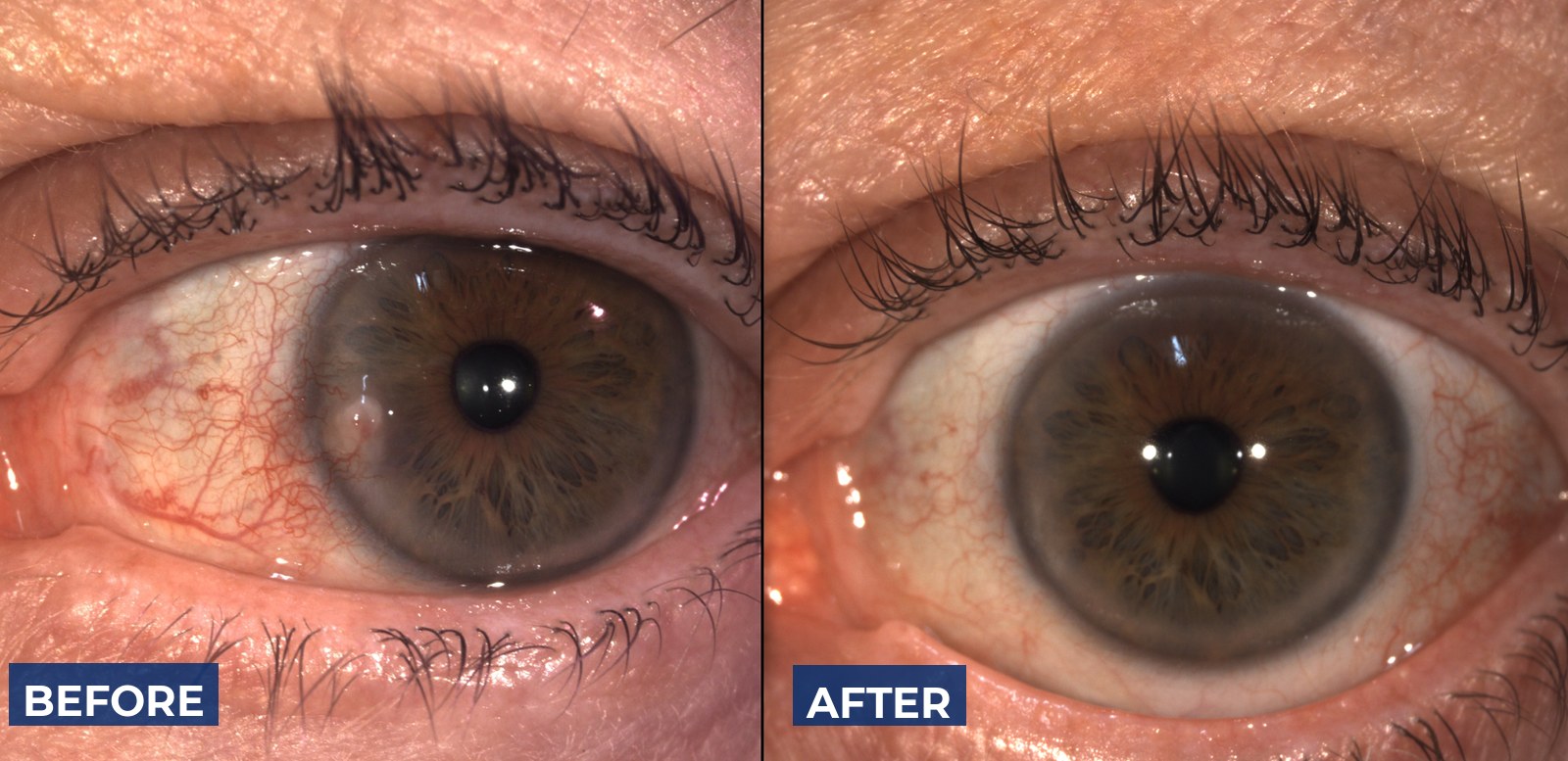 Before and after photographs of pterygium removal, showing the growth at the nasal edge of the cornea and the eye afterwards
