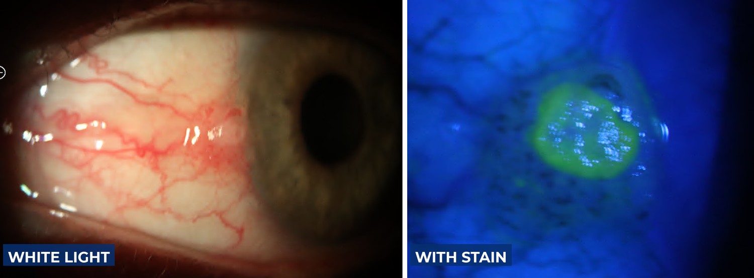 A raised conjunctival lesion with prominent feeder vessels, shown in white light and again under blue light with stain, which reveals its margins clearly