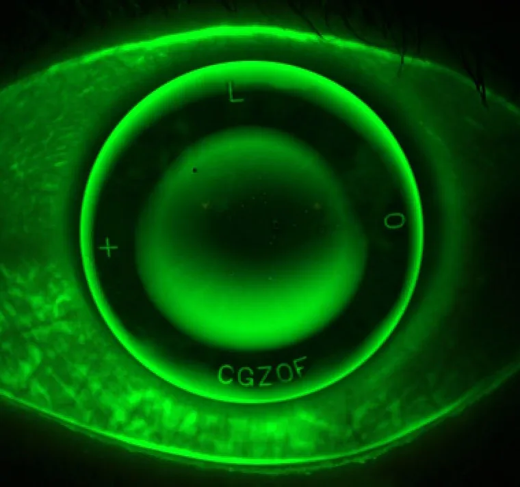 Fluorescein pattern of an overnight ortho-K contact lens fit, showing the concentric central treatment zone on the cornea