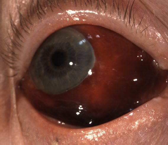 Slit lamp photograph of a dense, dark red subconjunctival haemorrhage covering most of the white of the eye