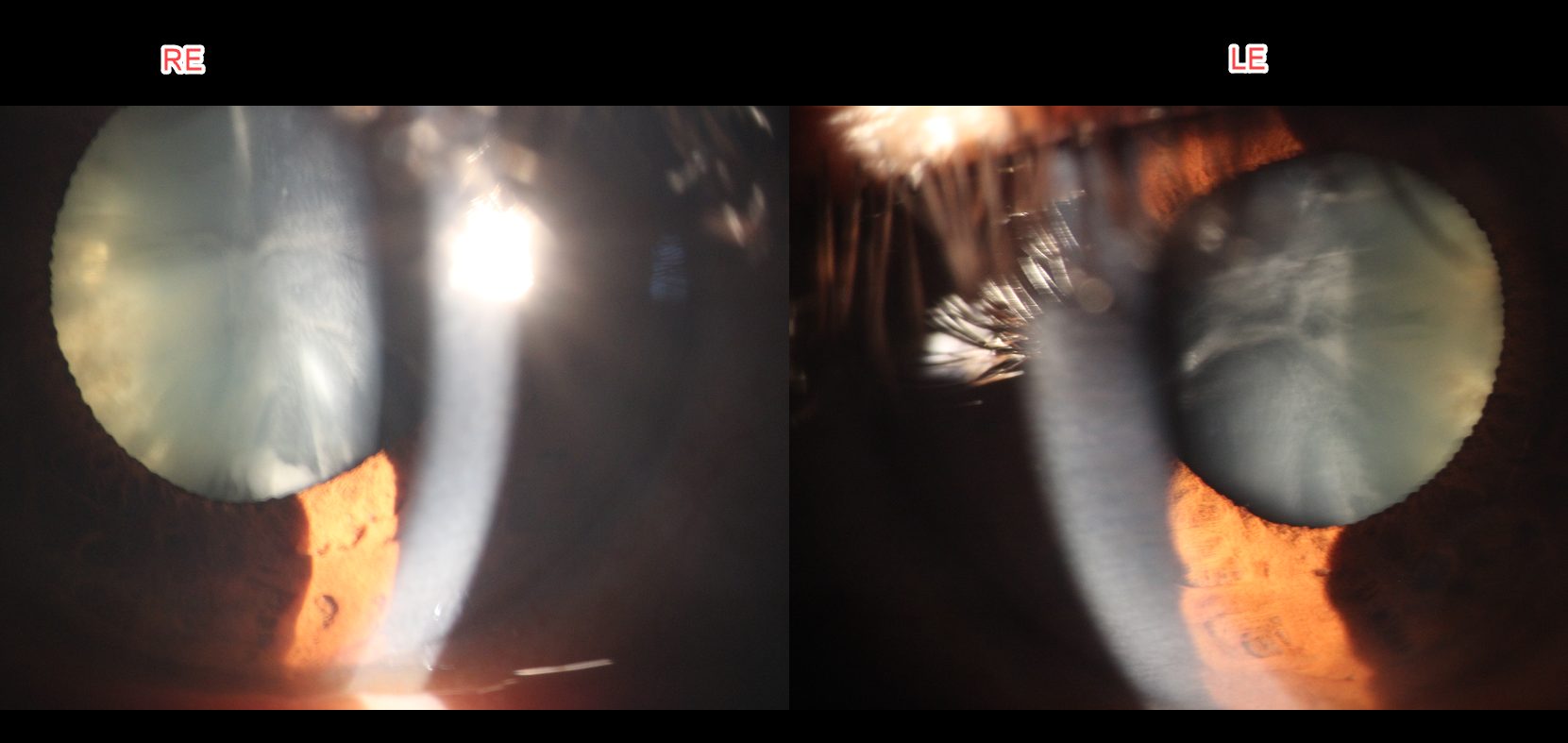 Slit lamp retroillumination photographs of right and left eyes showing cataract opacities against the red reflex