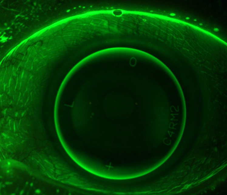 Fluorescein image of a rigid keratoconus lens on an eye, glowing green where the tear layer pools beneath the lens
