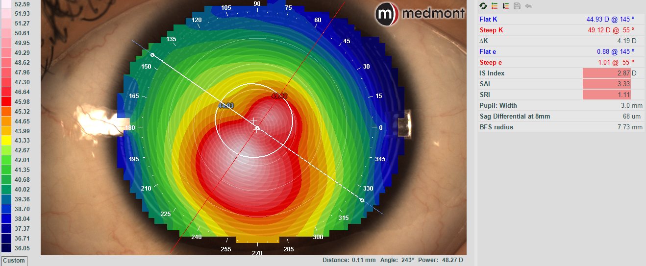 Medmont corneal topography axial map showing inferior steepening typical of keratoconus