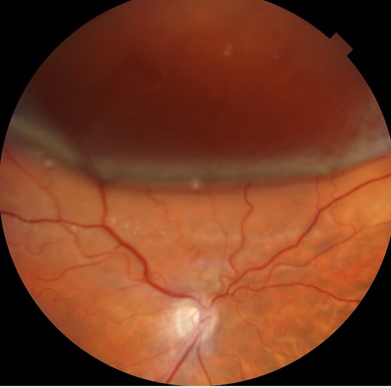 Fundus photograph of a retinal detachment: a dark elevated fold of retina billowing down from above against the attached orange retina below