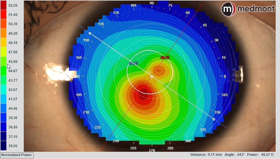 Corneal topography power map showing the cone-shaped steepening typical of keratoconus