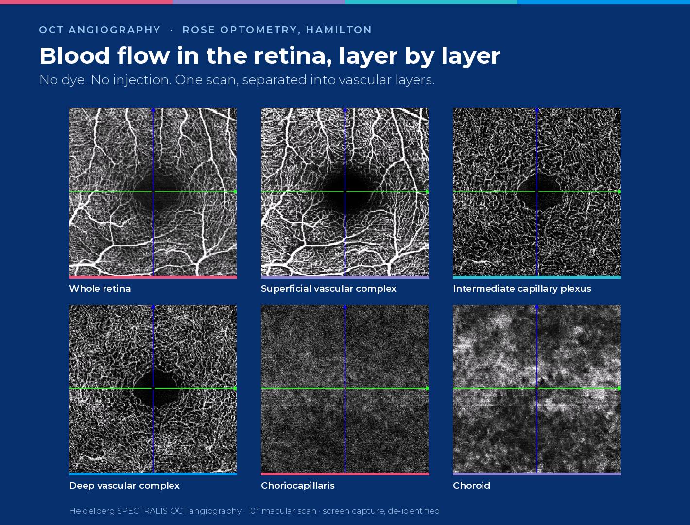 OCT angiography scan of the macula split into six vascular layers, from the superficial retinal vessels to the choroid
