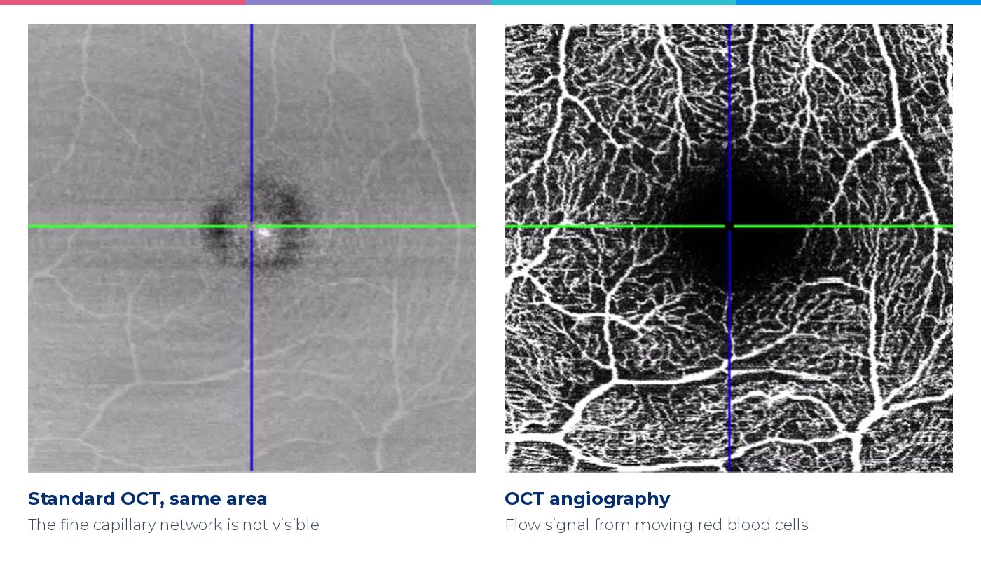 Side-by-side comparison of a standard OCT image and an OCT angiography image of the same area of the macula