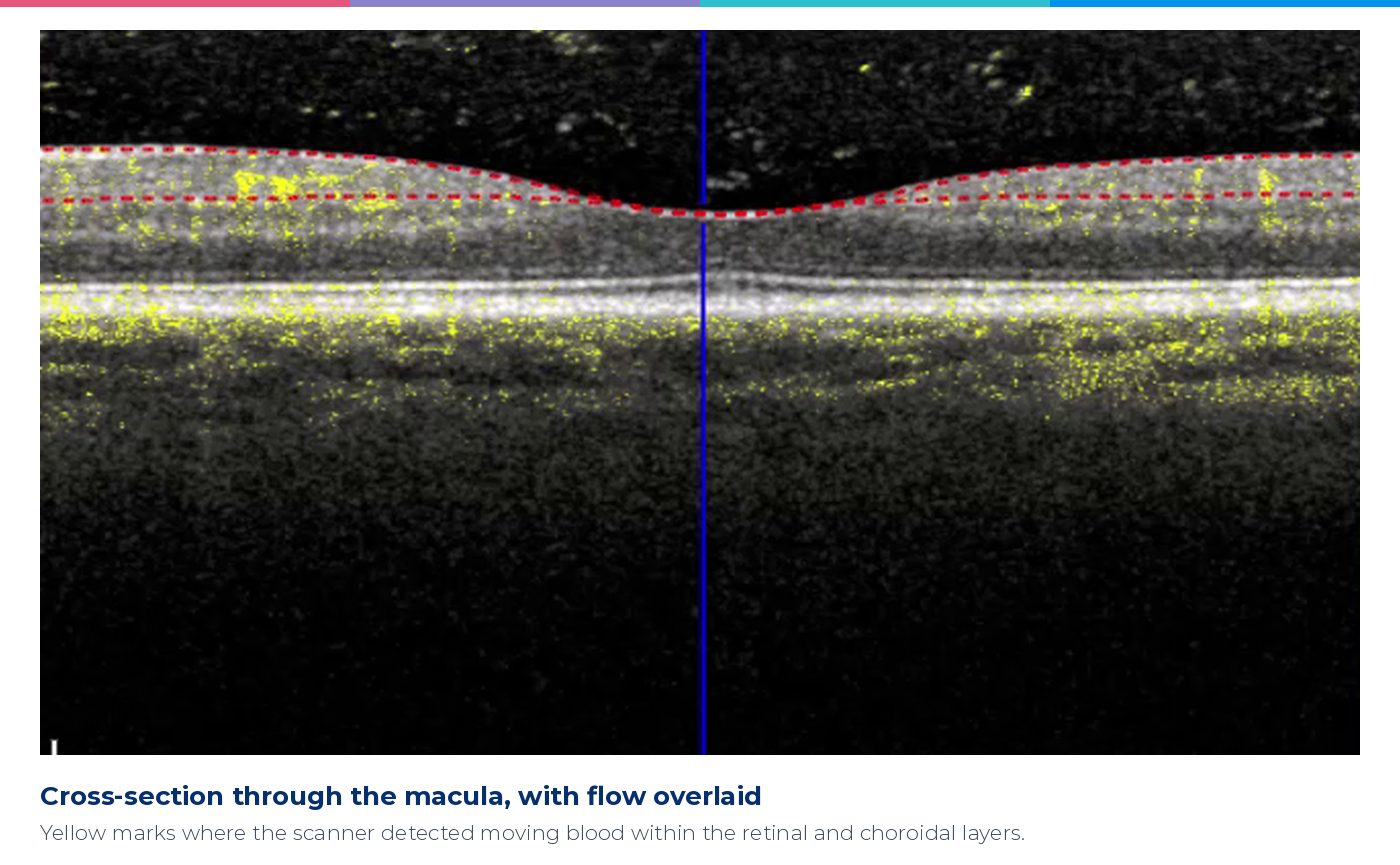OCT cross-section through the macula with blood flow overlaid in yellow
