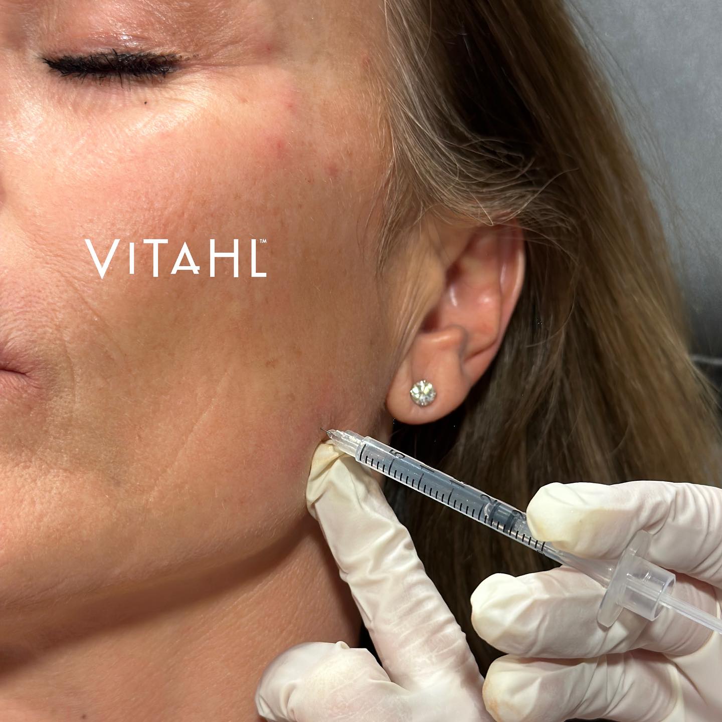 Radiofrequency Microneedling with Secret RF Vitahl Medical Aesthetics