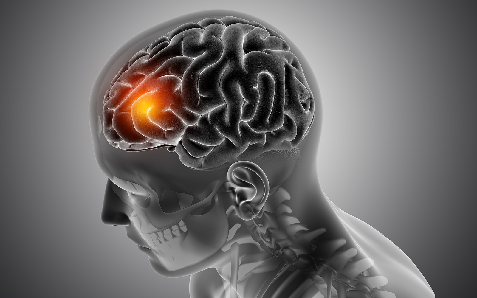 Ozone therapy for stroke, traumatic brain injuries, and other brain damage