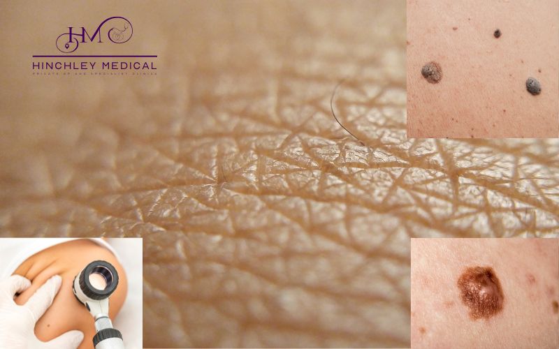 Mole assessments and skin check at Hinchley Medical Private GP and Specialist Clinics
