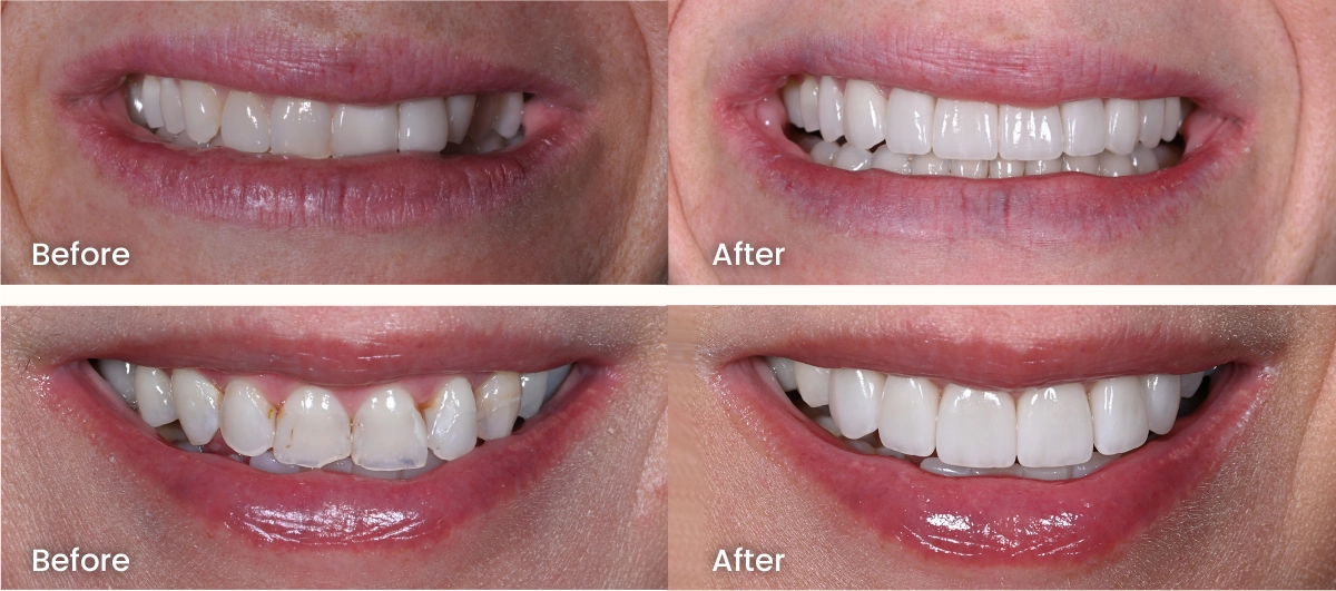 Before and after photos of patients' smiles restored with front tooth dental crowns at Scottsdale dentist