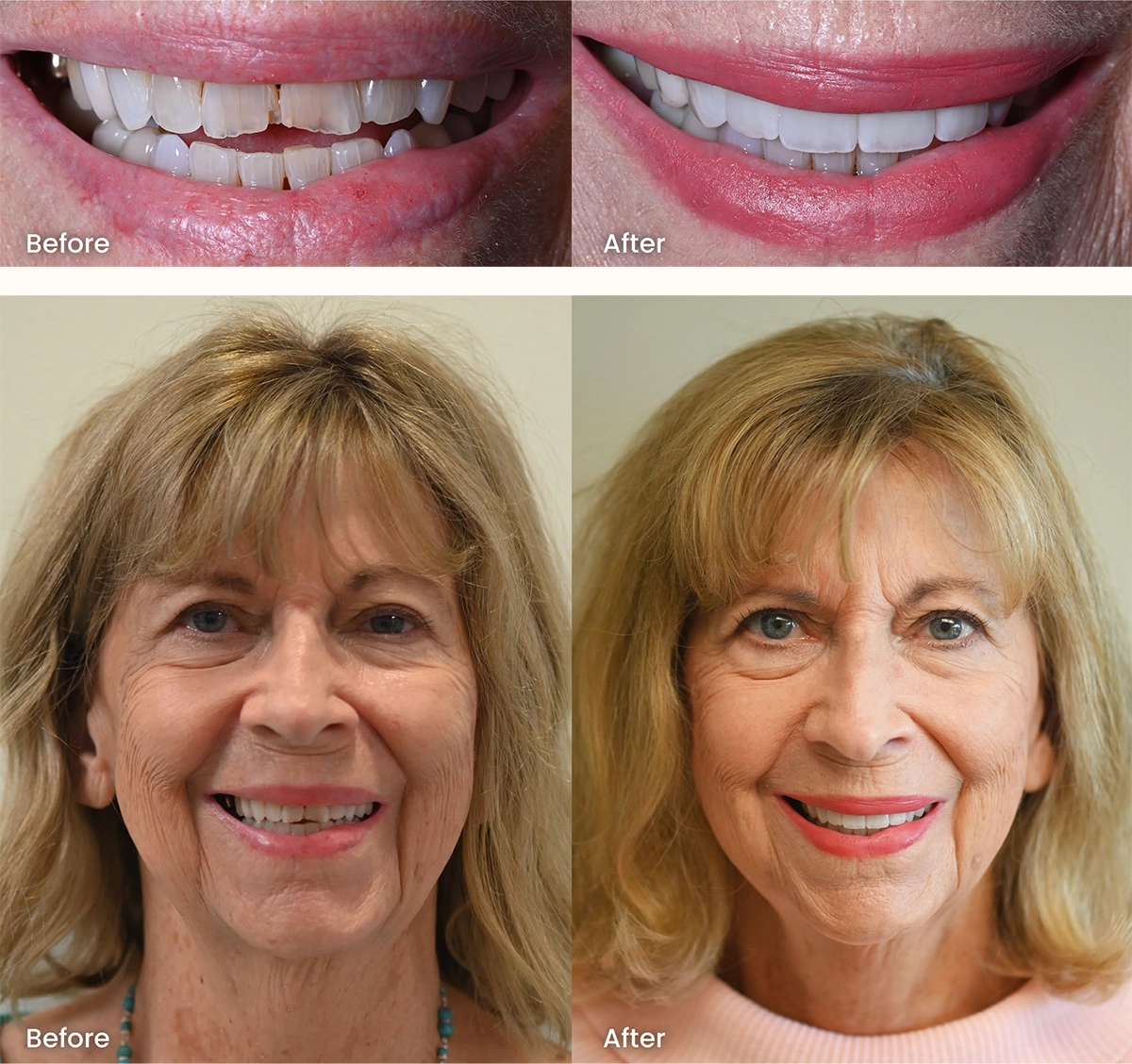Before and after photos of a Scottsdale patient with four new front dental crowns at Alpers Dentistry, showing natural color and seamless smile restoration.