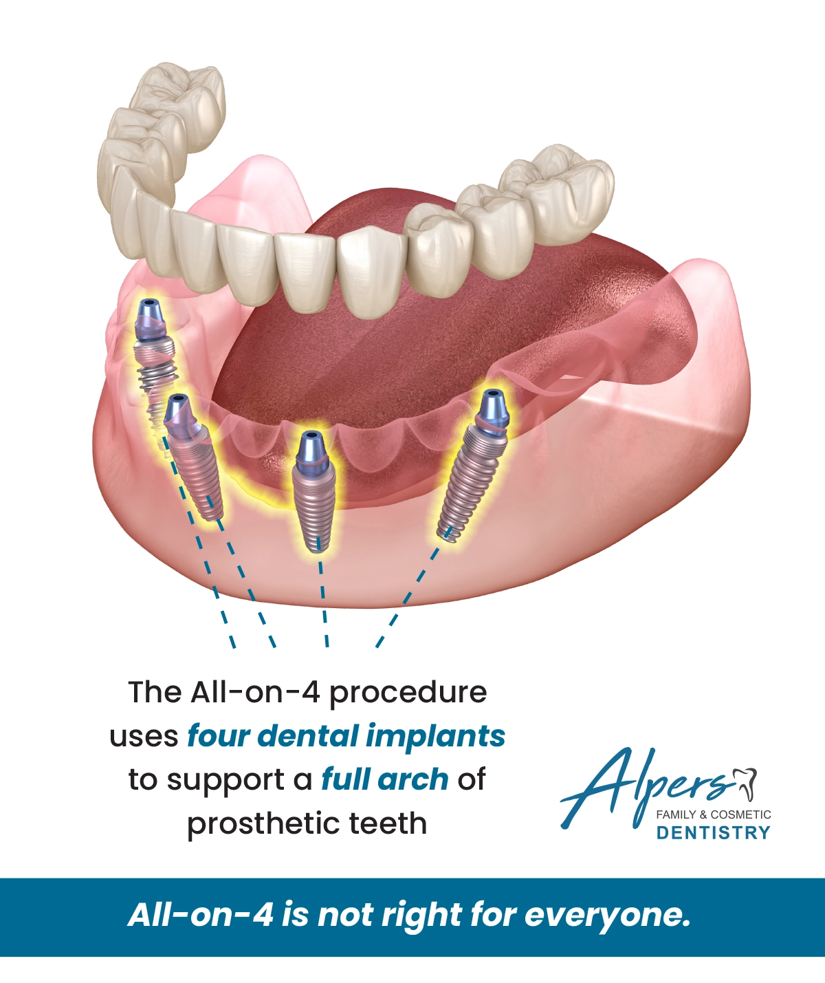 The all on 4 procedure uses four dental implants to support a full arch of prosthetic teeth. All on 4 is not right for everyone. Image of model with the four dental implants highlighted.