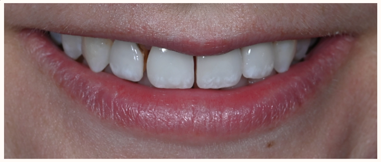picture of smile before four veneers treatment in scottsdale
