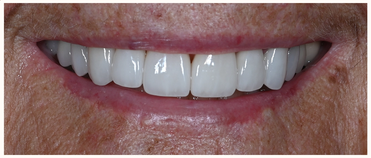 8 veneers treatment results in scottsdale