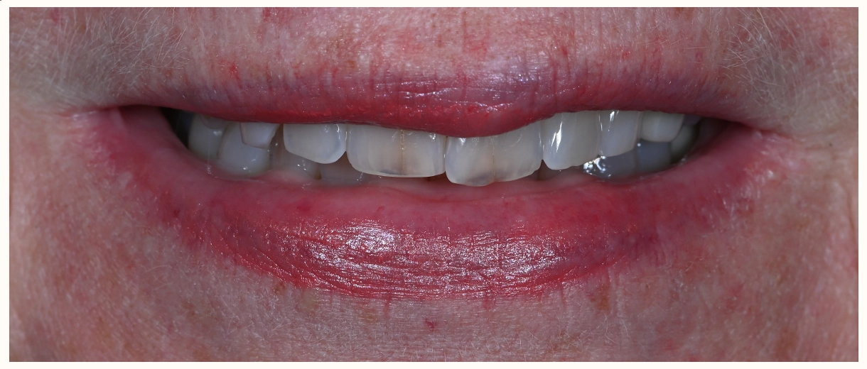 teeth before getting 2 custom veneers in scottsdale