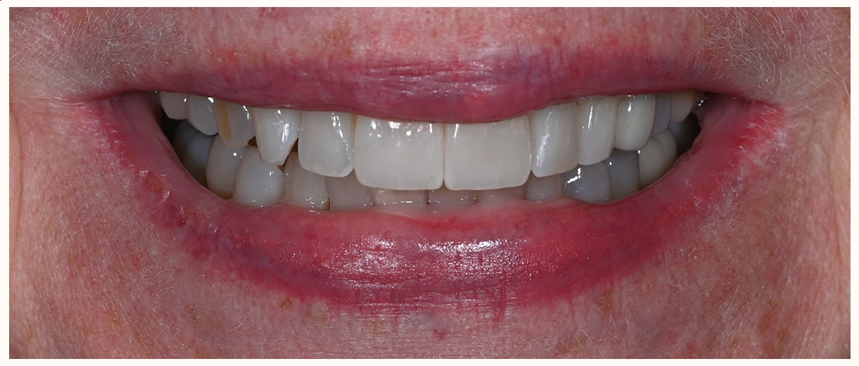 just 2 veneers treatment smile by a scottsdale dentist