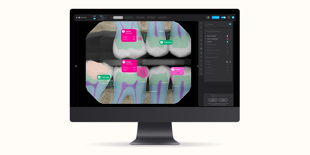 AI dental x-ray software from Pearl AI showing color-coded diagnosis on a patient’s teeth, used by Alpers Family Dentistry in Scottsdale.