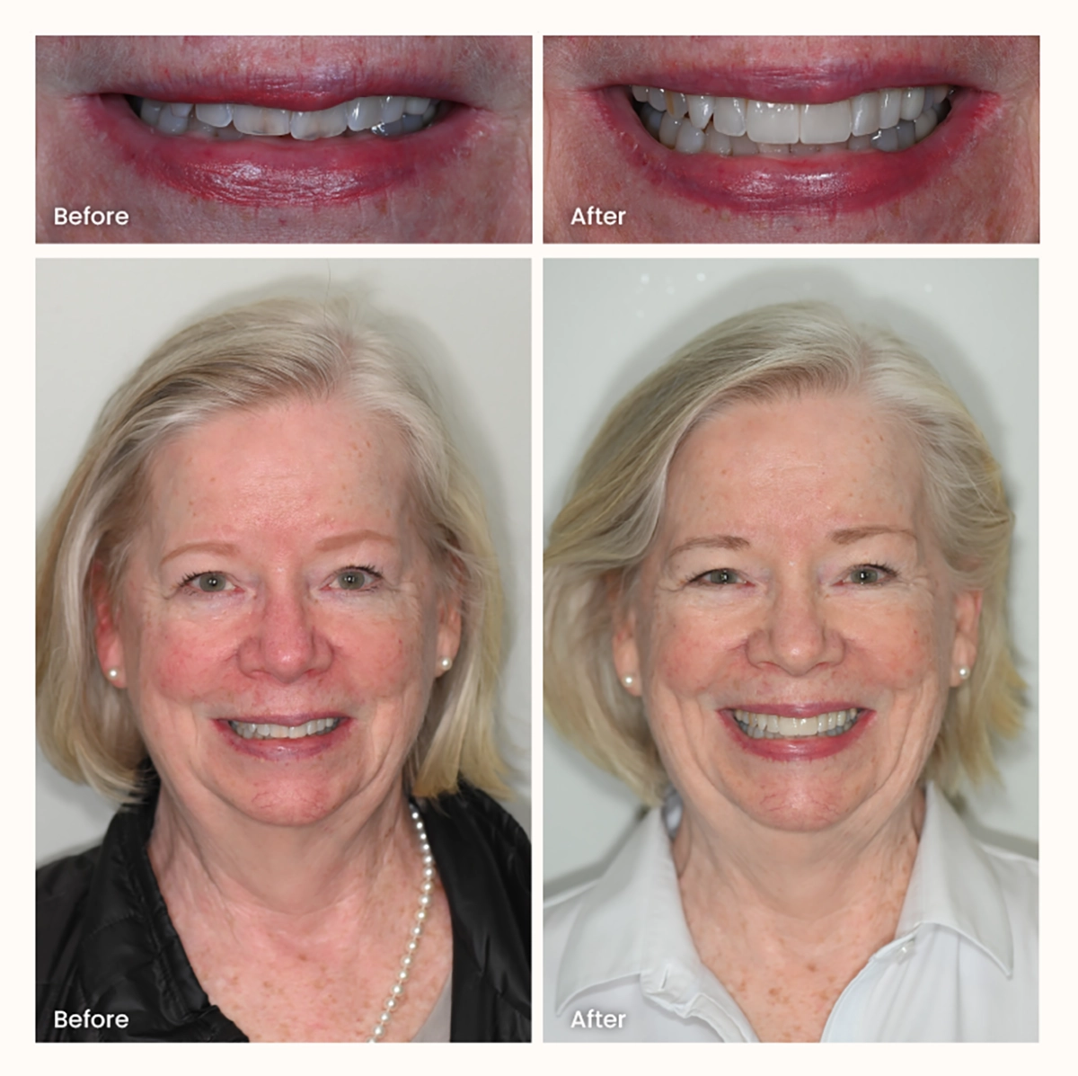 Before and after images of a Scottsdale patient smile after two veneers were placed on the front teeth, showing a natural blend with surrounding teeth.