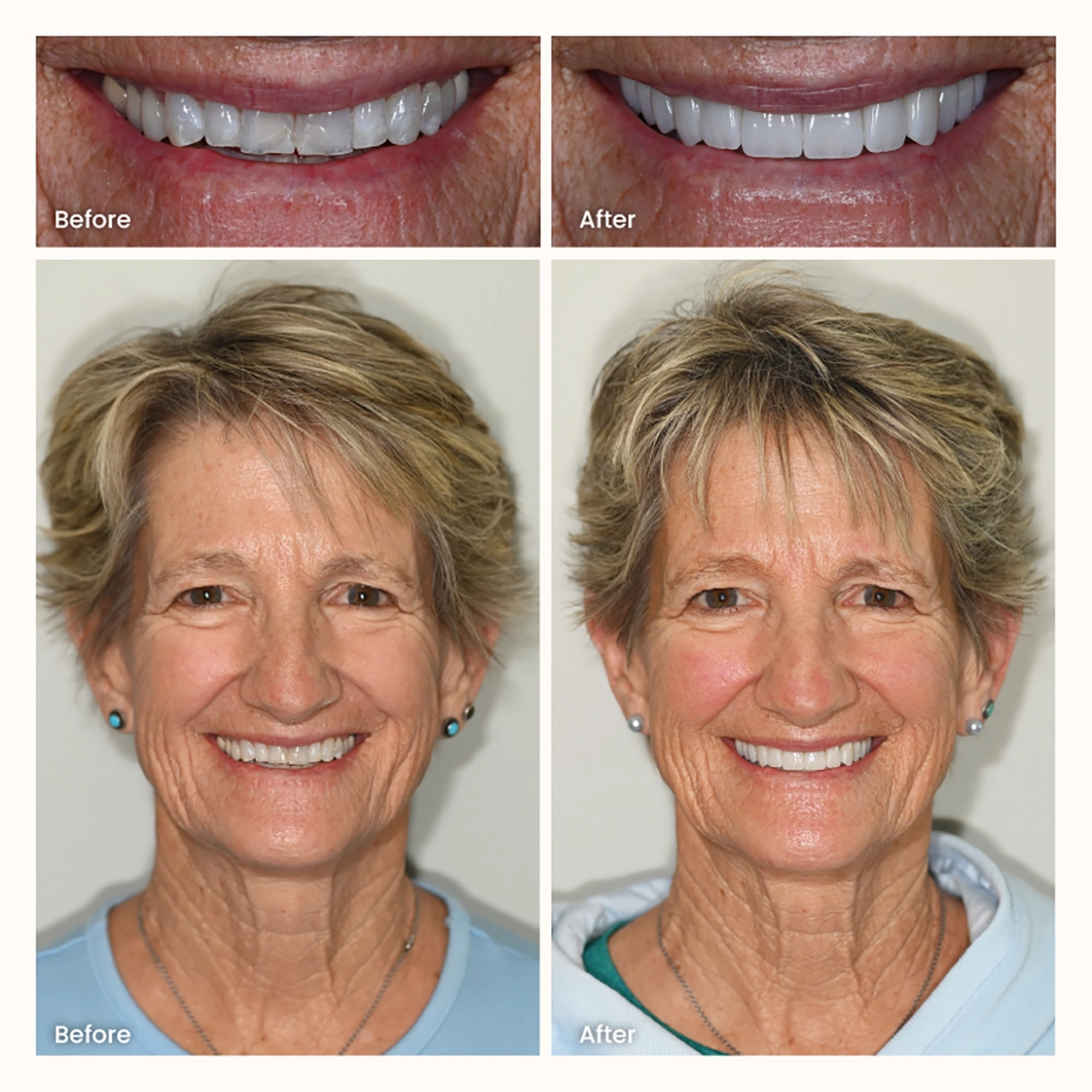 Scottsdale patient smile after 12 veneers showing a balanced, natural-looking full smile transformation across the upper front teeth.