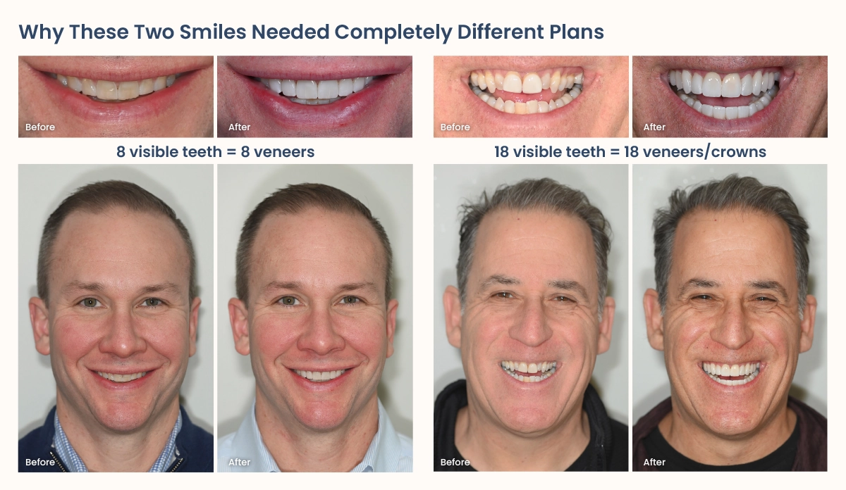 Side-by-side comparison of two patient smiles in Scottsdale AZ showing different veneer treatments, one with 8 veneers for a narrower smile and one with 18 veneers for a wider smile that shows both upper and lower teeth.