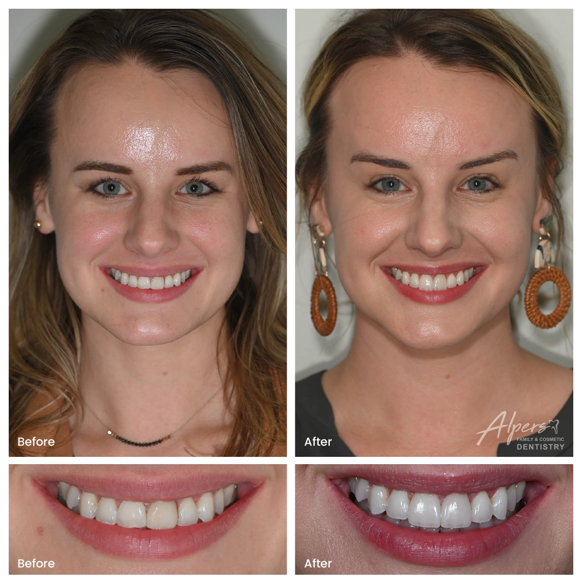 Before and after photos of a patient with two natural-looking veneers showing a subtle smile enhancement without a fake appearance.